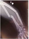 fracture avant bras 1